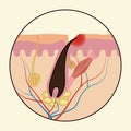 Ingrown hairs. Medical scheme of hair regrowth.